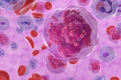 A leucemia &eacute; o c&acirc;ncer mais comum em crian&ccedil;as e jovens -  (crédito: Portal Giro 10)