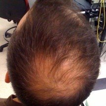 Descoberta pode mudar os tratamentos contra a queda de cabelo - Welshsk, CC BY 3.0, via Wikimedia Commons
