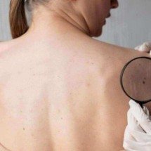 Câncer de pele: especialista explica causas, sinais de alerta e tratamento - Freepik