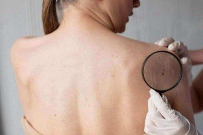 A preven&ccedil;&atilde;o &eacute; a chave para reduzir a incid&ecirc;ncia da neoplasia  -  (crédito: Freepik)