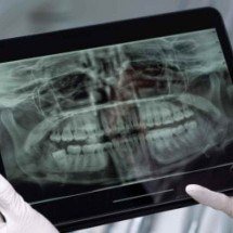 Saliva artificial ajuda a proteger os dentes de pacientes com câncer  -  Freepik