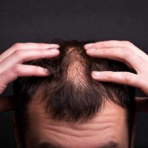 Calvície genética dá para evitar? O que a ciência já consegue fazer - Freepik