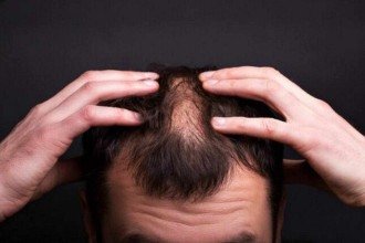 Calvície genética dá para evitar? O que a ciência já consegue fazer