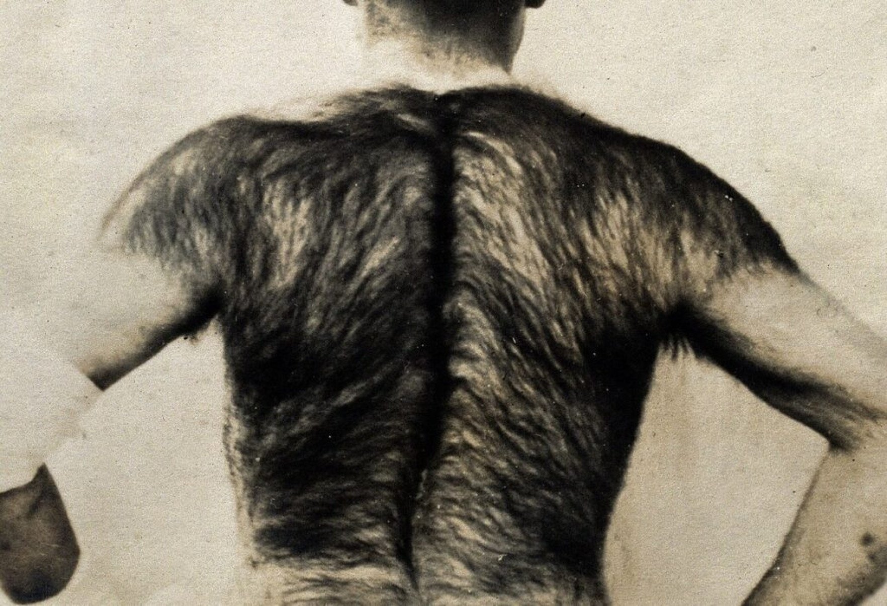 Síndrome do homem lobo: fatos e curiosidades sobre a hipertricose - Portal Giro 10