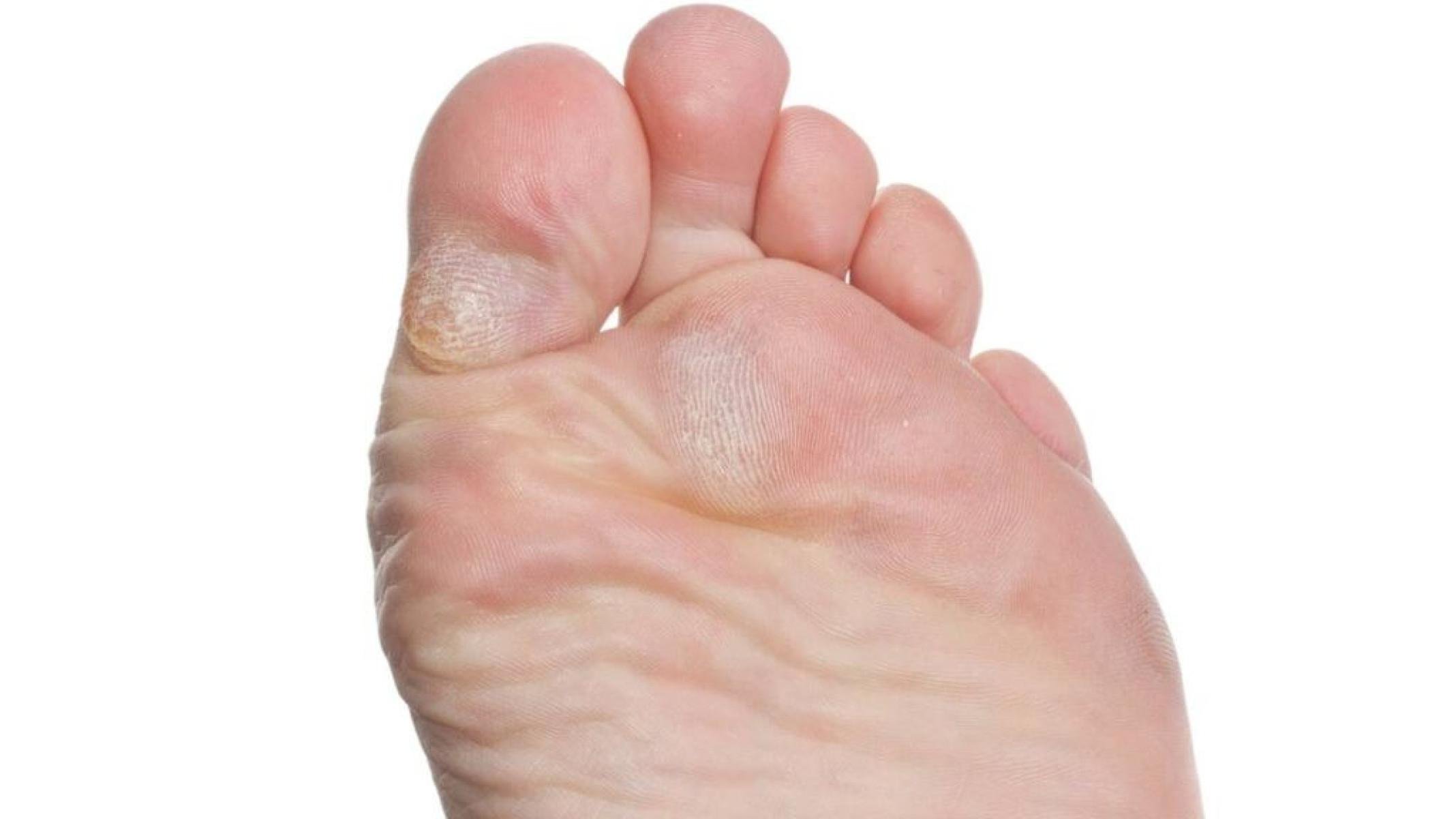Calo no pé: por que aparece, como tratar com segurança e o que fazer para evitar o problema - Portal Giro 10