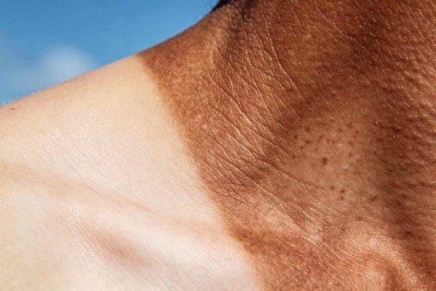 Saiba como prevenir o câncer de pele com cuidados simples no dia a dia -  (crédito: Tupi)