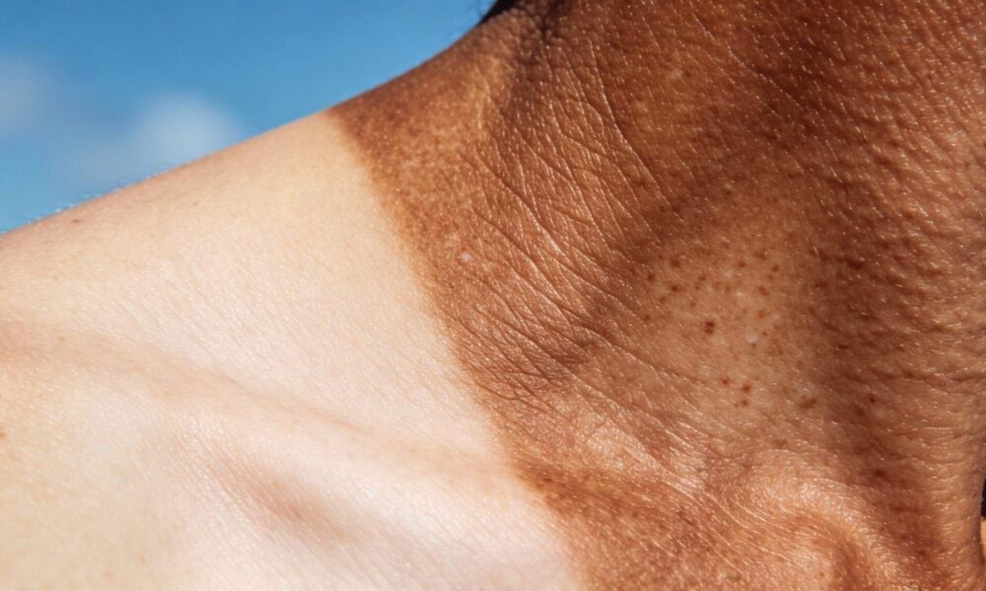 Saiba como prevenir o câncer de pele com cuidados simples no dia a dia - Tupi