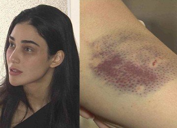 Pollyana teve hematomas por todo o corpo devido às agressões -  (crédito: TV Alterosa)