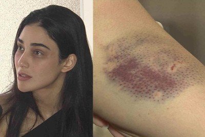 Pollyana teve hematomas por todo o corpo devido às agressões -  (crédito: TV Alterosa)