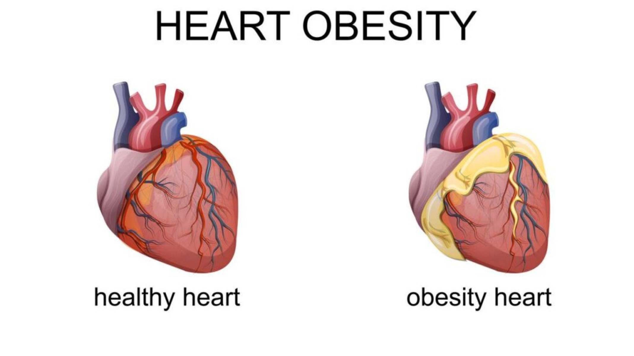 Gordura pericárdica: o risco silencioso para a saúde do coração - Portal Giro 10