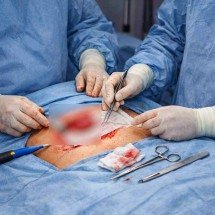 Erro em cirurgia de hérnia faz homem perder um testículo  - imagem gerada por inteligência artificial/acervo Estado de MInas