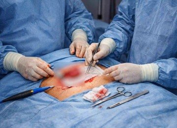 Cirurgia de hérnia; imagem meramente ilustrativa -  (crédito: imagem gerada por inteligência artificial/acervo Estado de MInas)