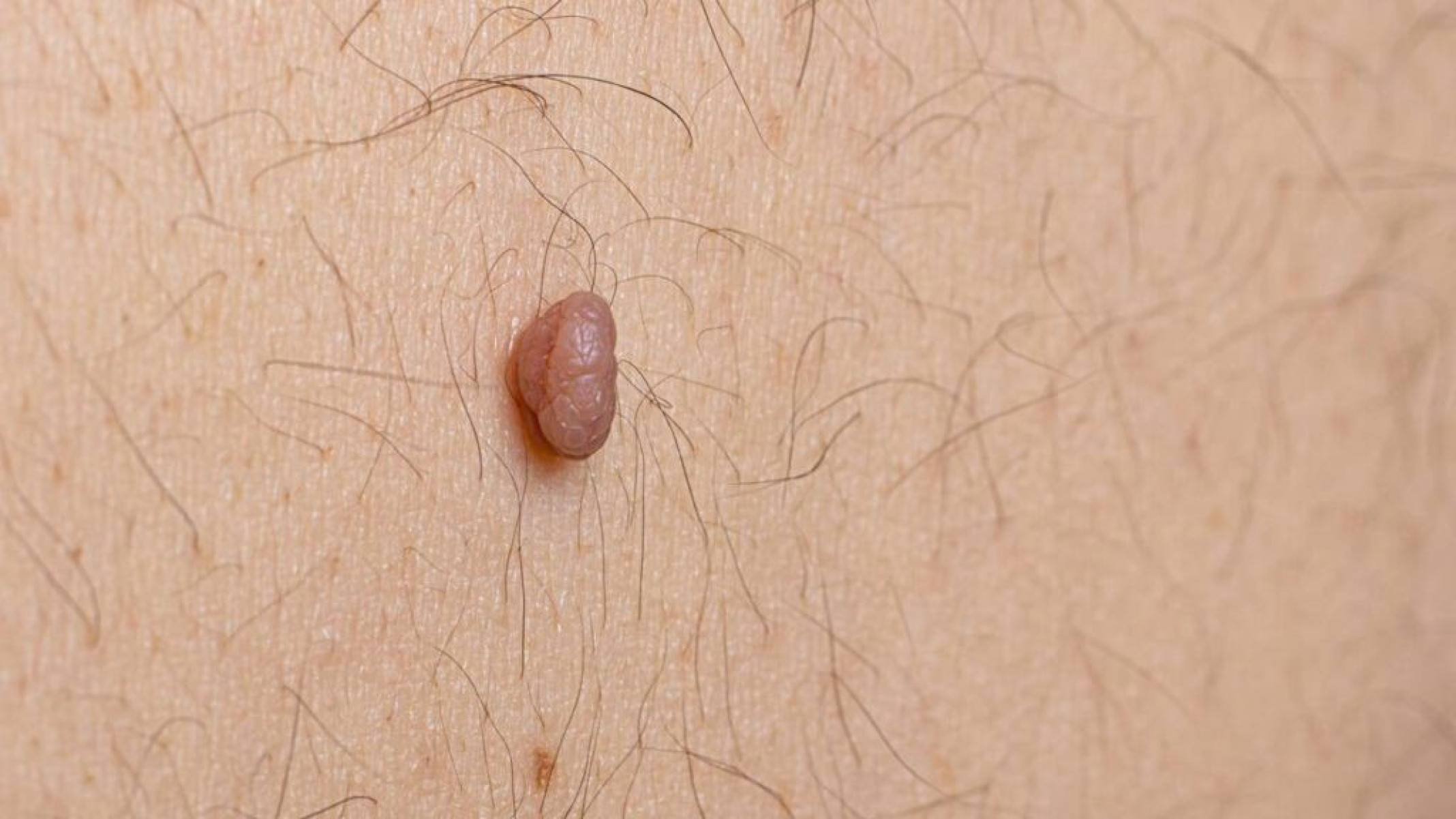 O que são sinais no corpo e por que aparecem ao longo da vida - Portal Giro 10