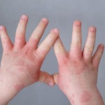 Dermatite atópica atinge duas em cada 10 crianças com menos de cinco anos - Freepik