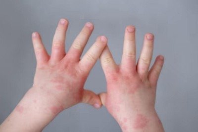 Com a doença, a pele fica mais suscetível à penetração de substâncias potencialmente sensibilizantes e irritantes, que desencadeiam a inflamação -  (crédito: Freepik)