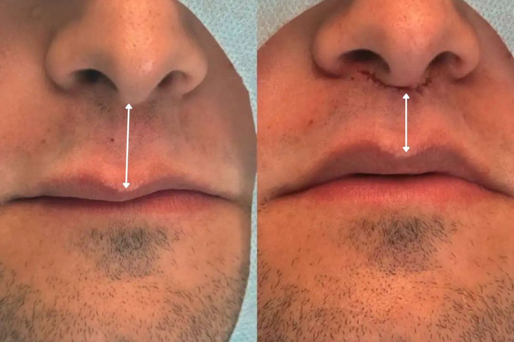 Lip Lift amplia opções de rejuvenescimento sem volume -  drfabiobarros.com.br