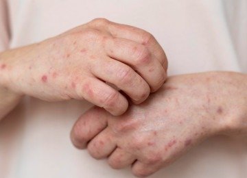 Les&otilde;es na pele que co&ccedil;am e se espalham s&atilde;o sintomas comuns de doen&ccedil;as como mpox e catapora, conforme detalhado na mat&eacute;ria. -  (crédito: Freepik)