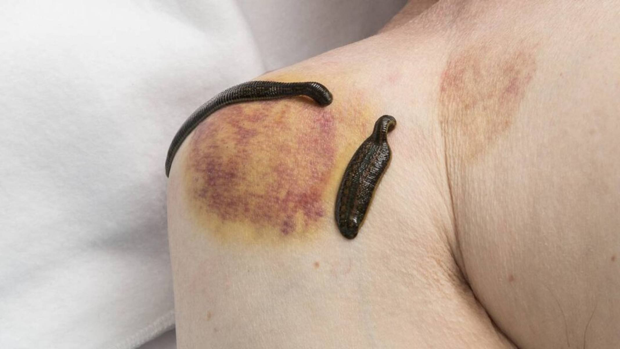 As sanguessugas funcionam mesmo na medicina? - Portal Giro 10