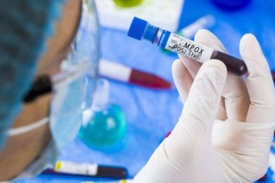 Mpox no Brasil: conheça as duas variantes e o risco real para a população -  (crédito: Portal Giro 10)