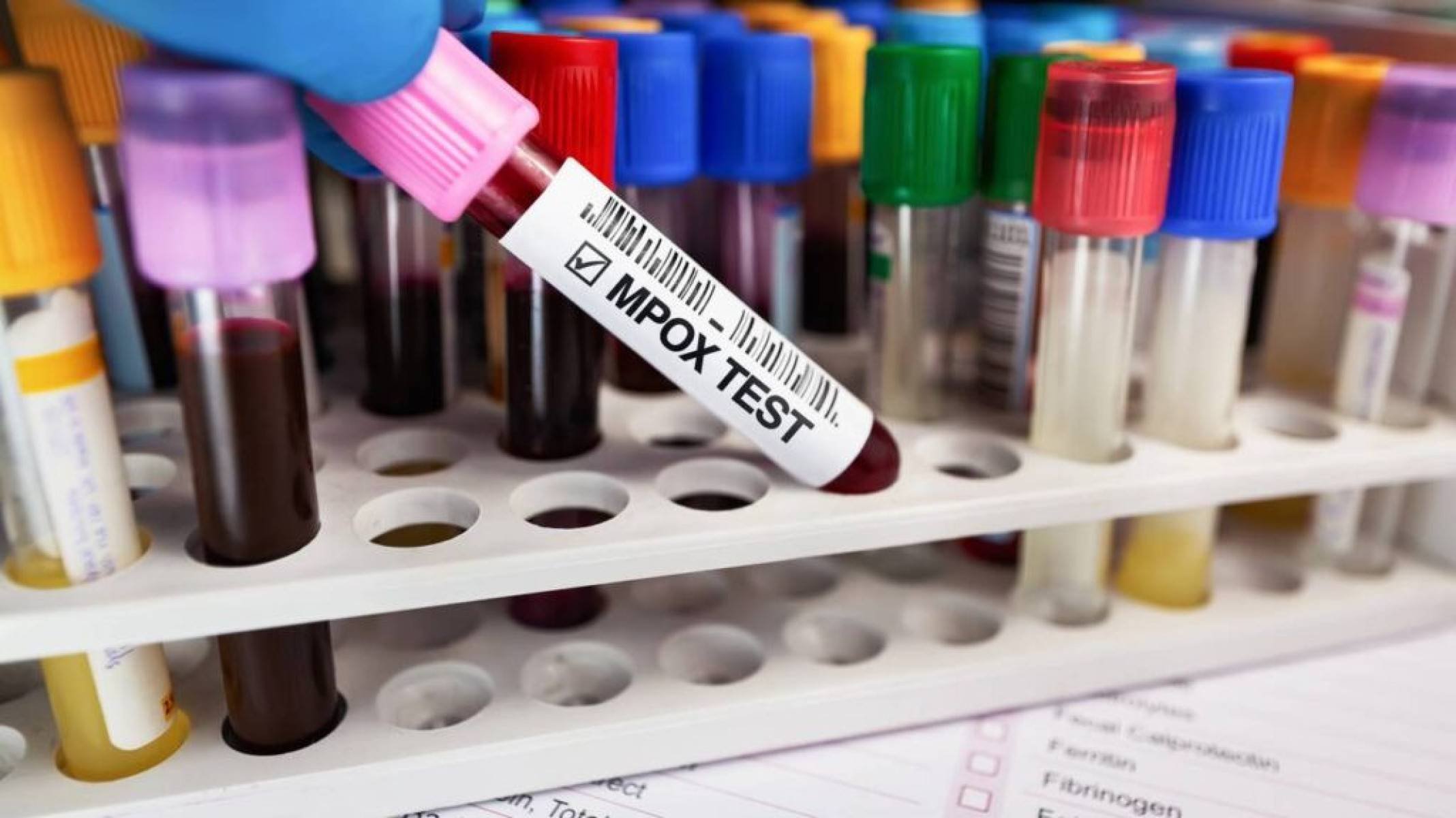 Como a ciência está combatendo o avanço da Mpox - Portal Giro 10