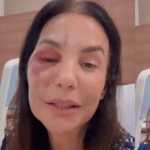 Ivete Sangalo passa por cirurgia após sofrer fraturas no rosto em acidente doméstico - Reprodução de redes sociais 