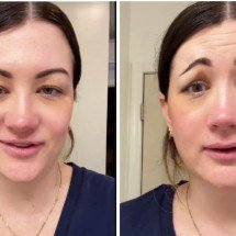 Erro de aplicação de botox deixa mulher com ‘cara de palhaço triste’ - TikTok / reprodução