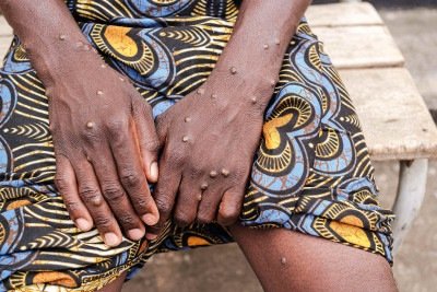Les&otilde;es na pele s&atilde;o um dos sintomas caracter&iacute;sticos da mpox, cuja identifica&ccedil;&atilde;o &eacute; crucial para o diagn&oacute;stico e preven&ccedil;&atilde;o -  (crédito: Tchandrou NITANGA / AFP)
