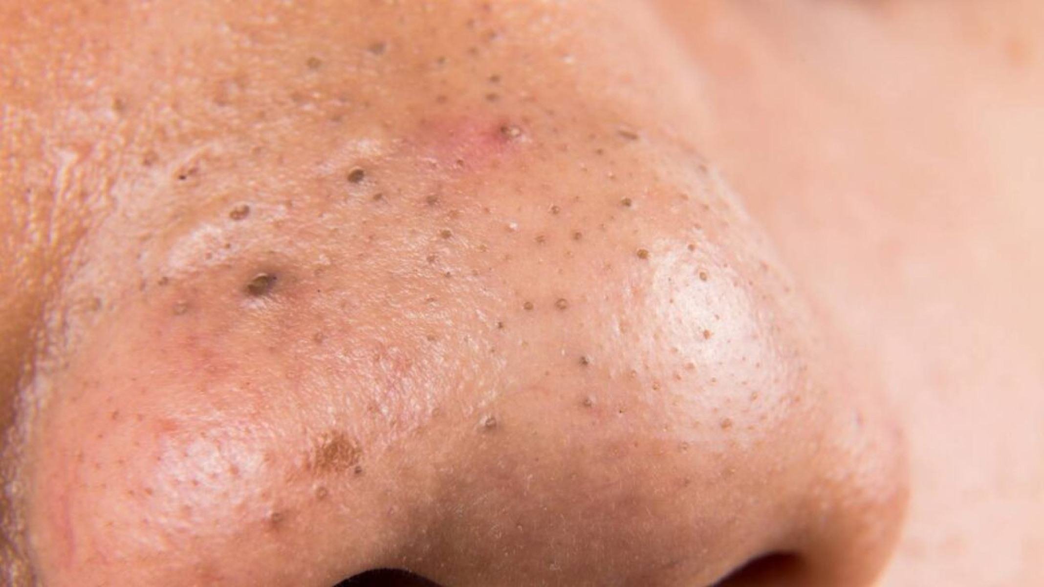 Cravos x espinhas: entenda as diferenças e como tratar cada um - Portal Giro 10