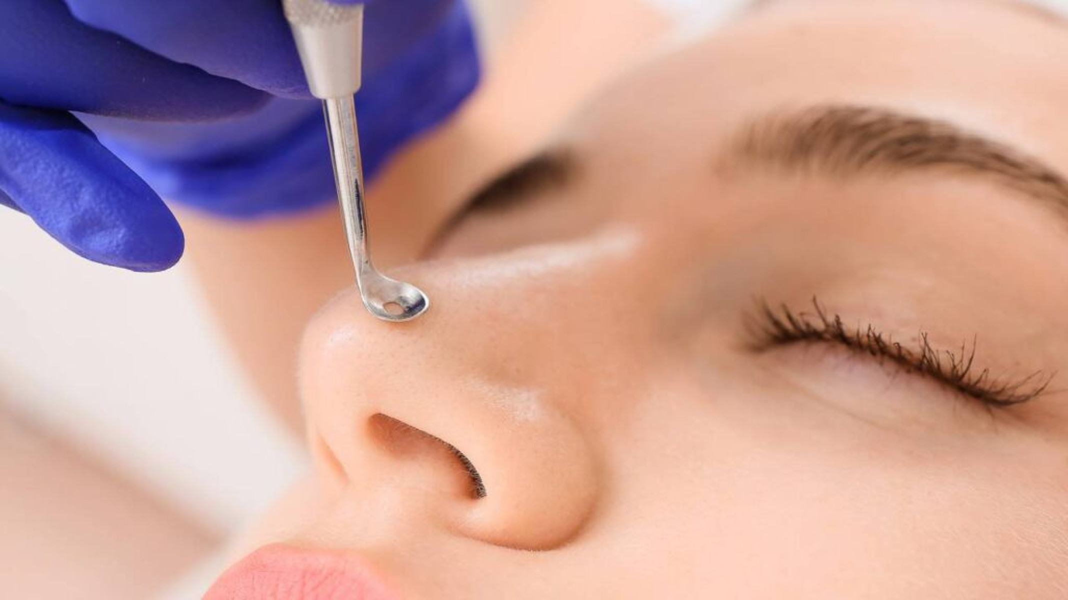 Cravos no corpo: entenda por que surgem e como evitar - Portal Giro 10