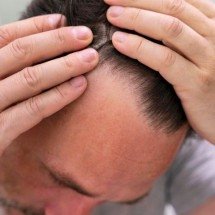 Precisa? Alimentos que ajudam a prevenir a calvície - freepik