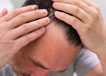 <p>A calvície afeta principalmente os homens e está ligada a fatores genéticos, hormonais e também alimentares. Uma dieta equilibrada ajuda a fornecer nutrientes importantes para a saúde dos cabelos.</p>
 -  (crédito: freepik)