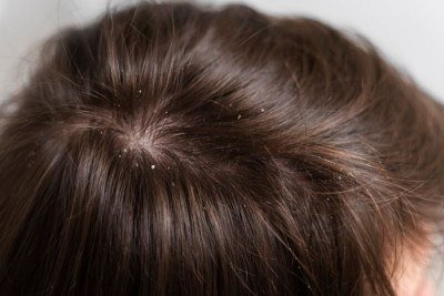 <p>A caspa é uma descamação excessiva do couro cabeludo causada por fatores como oleosidade, ressecamento, estresse ou micro-organismos naturais. Embora não seja grave, pode causar coceira, irritação e constrangimento, exigindo cuidados adequados para prevenção e tratamento.</p>
 -  (crédito: Freepik)