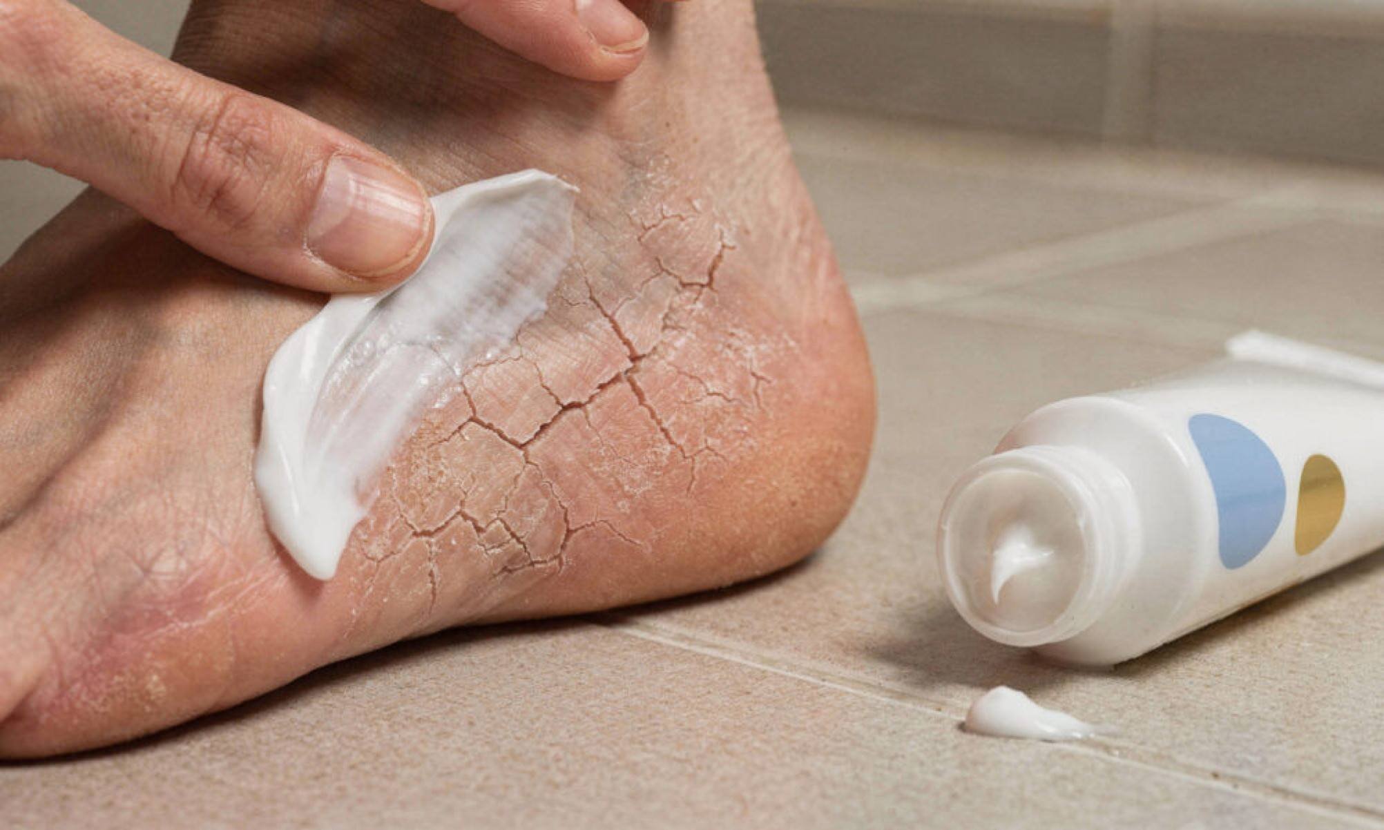 Como cuidar de calcanhares ressecados e rachados em casa de forma rápida e eficiente -  (crédito: Tupi)