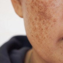 Nem toda mancha no rosto é melasma: saiba como identificar - Pixabay
