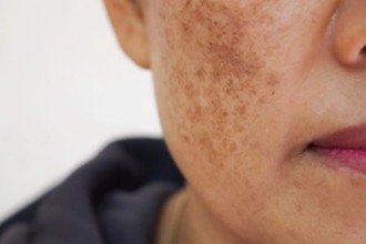 'Antes de pensar apenas em clarear, é preciso acertar o diagnóstico', diz médica -  (crédito: Pixabay)