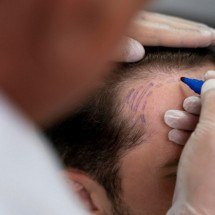 Transplante capilar é definitivo? Veja quando pode ser necessário refazer - Freepik