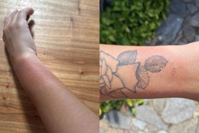 F&atilde;s postaram nas redes sociais fotos de queimaduras ap&oacute;s usarem pulseiras distribu&iacute;das no show de Luan Santana em BH -  (crédito: Reprodu&ccedil;&atilde;o/Redes sociais)