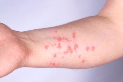 As erup&ccedil;&otilde;es cut&acirc;neas na pele  s&atilde;o um sintoma caracter&iacute;stico da Mpox que aparecem ap&oacute;s a fase inicial da infec&ccedil;&atilde;o. -  (crédito: Mpox / Getty Images)