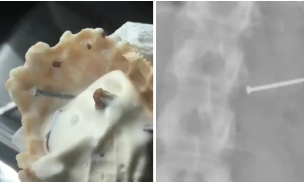 Sorvete com peda&Atilde;&sect;os de metal e raio-x mostrando prego no organismo de cliente