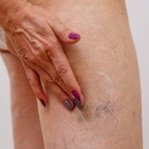 Influenciadora fala sobre cirurgia e levanta debate sobre saúde vascular - Freepik