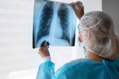 A tuberculose é uma doença infecciosa que está entre as mais antigas da humanidade. Causada pela bactéria Mycobacterium tuberculosis, mais conhecida como bacilo de Koch, ela afeta principalmente os pulmões, mas pode atingir outros órgãos, como rins, ossos e sistema nervoso. 
 -  (crédito:  Imagem Freepik)