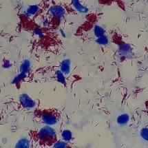 Exame de sangue associado a IA é usado no diagnóstico precoce de Hanseníase - Ajay Kumar Chaurasiya/Wikimedia Commons