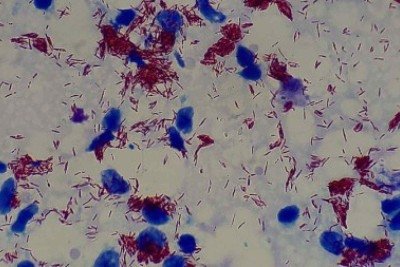 Amostra de lesão de pele com Mycobacterium leprae (os fiapos vermelhos), vista ao microscópio em aumento de 1.000 vezes -  (crédito: Ajay Kumar Chaurasiya/Wikimedia Commons)