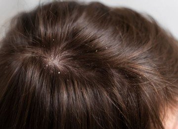 Caracterizada pela descamação do couro cabeludo, a caspa pode surgir por fatores como oleosidade, estresse ou micro-organismos. Embora não seja grave, pode causar desconforto e exige cuidados adequados.
 -  (crédito: Freepik)