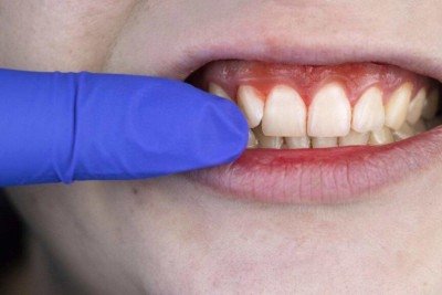 O escudo invisível da boca: como proteínas vegetais podem substituir a saliva natural -  (crédito: Portal Giro 10)