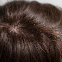 Dicas simples para dar adeus à caspa de uma vez por todas - Freepik