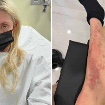 Taylor Momsen, de 'Gossip girl', é picada por aranha venenosa; veja estado - Redes sociais