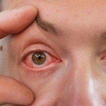 Olho vermelho ao acordar: causas como olho seco, alergias e ambiente explicadas de forma clara com sinais de alerta e cuidados básicos - Portal Giro 10
