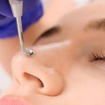 Cravos e espinhas: entenda como se formam dentro do poro e por que espremer pode piorar a inflamação da pele - Portal Giro 10