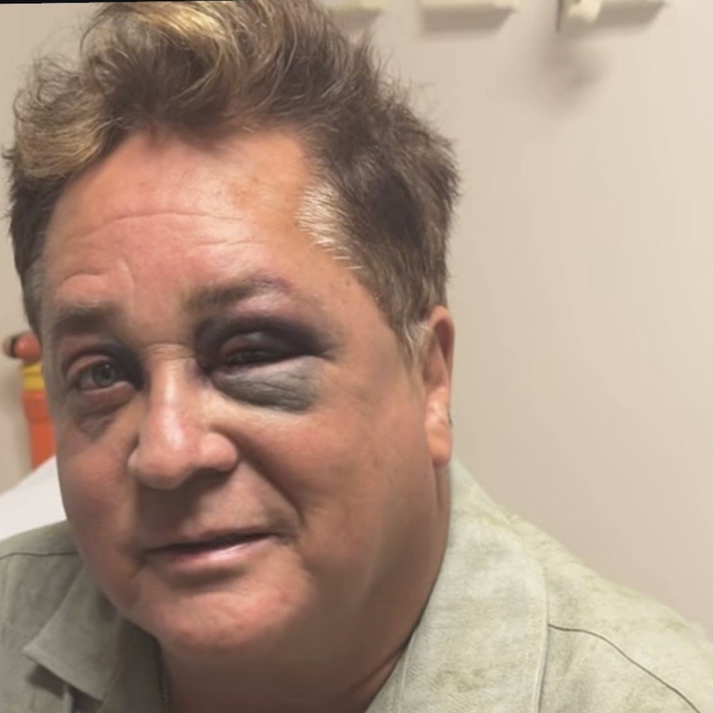 Cantor Leonardo surge com olhos roxos e assusta fãs; entenda